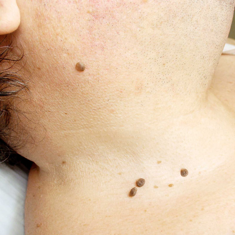 Skin growths